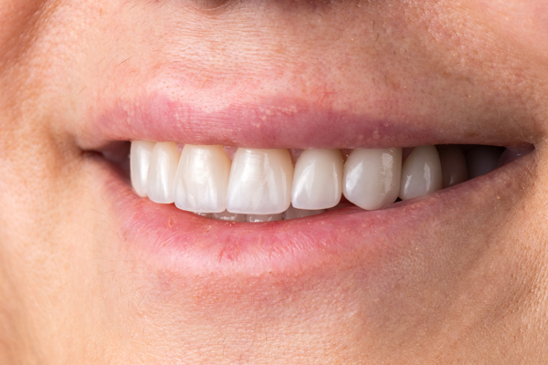 When CEREC Crowns May Be Recommended