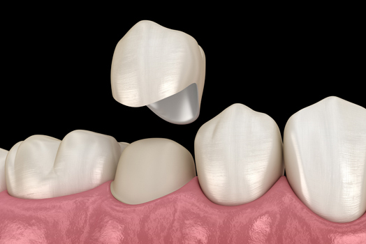 Same Day Crowns: How You Can Restore Your Smile In A Single Visit