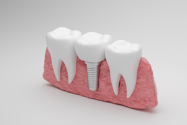Signs You Might Need Dental Implants Sooner Than You Think